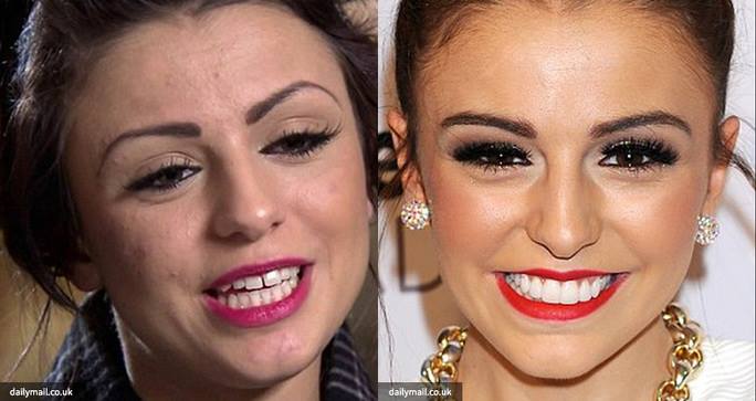 hollywood smile makeover example