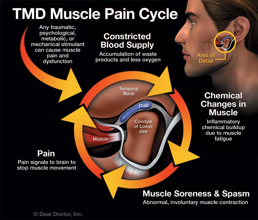 Temporale mandibuläre Dysfunktion Muskel-Schmerz-Zyklus
