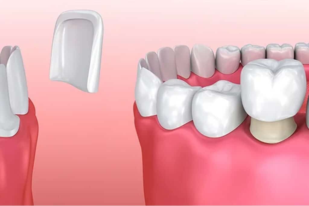 crowns vs dental veneers featured image
