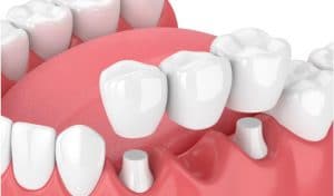 example of fixed partial denture (dental bridge)