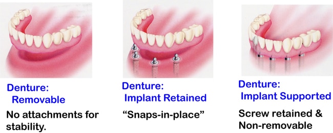 implant retained denture vs conventional denture vs implant supported denture
