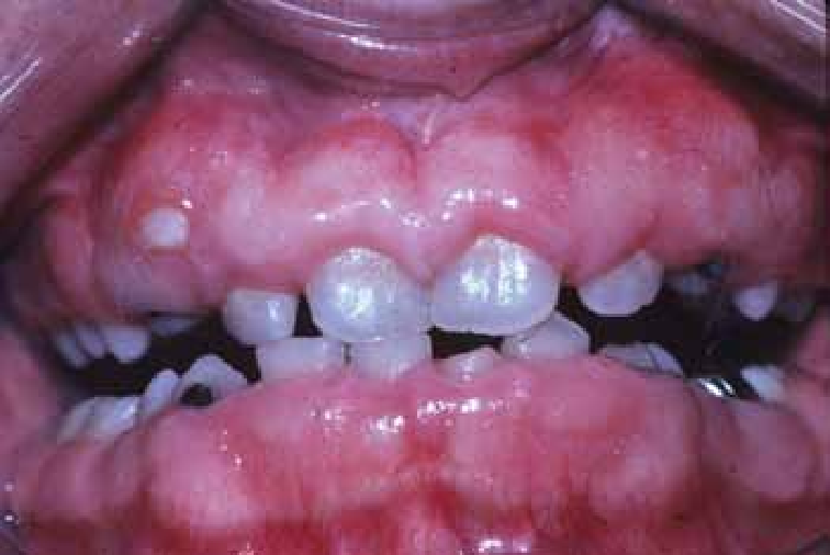 Hereditary Gingival Fibromatosis in a child causes gummy smile overgrowth