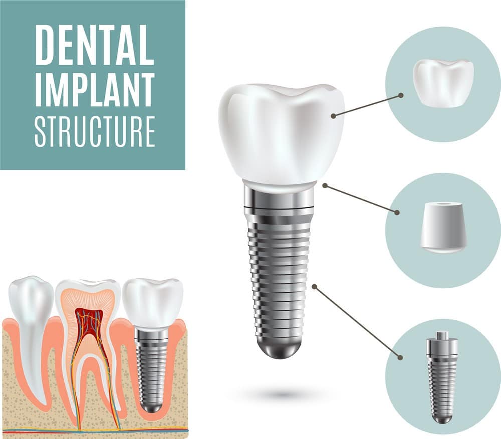 estrutura do implante dentário
