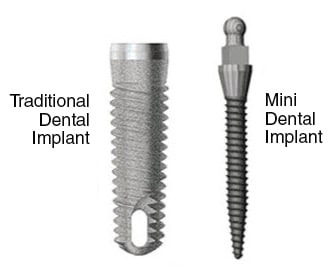 difference between mini implants and traditional dental implants