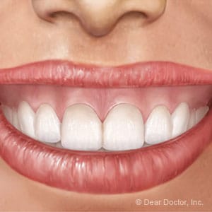 嘴唇涨得太高的胶质微笑；通过降唇术矫正的图片波士顿胶质微笑专家。