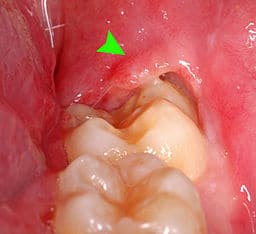 beeld van een gezwollen verstandskies die een kaakverstuiving kan veroorzaken als gevolg van een ontsteking