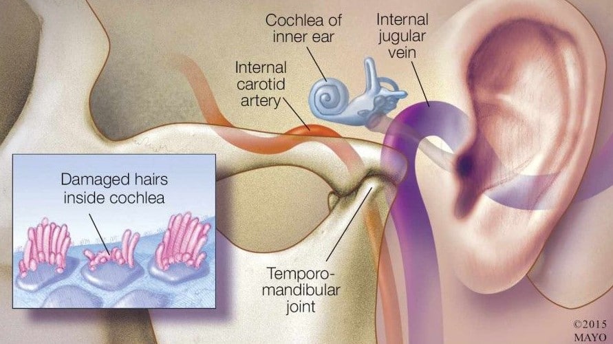 La proximidad al oído puede causar tinnitus y dolor de oído.