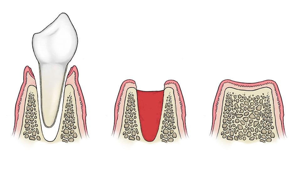 Combien de temps faut-il pour fermer le trou après l'extraction d'une dent ?