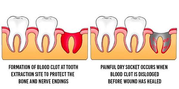 dry socket after tooth extraction illustration
