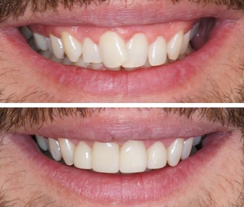 lip repositioning surgery and veneers to fix gummy smile