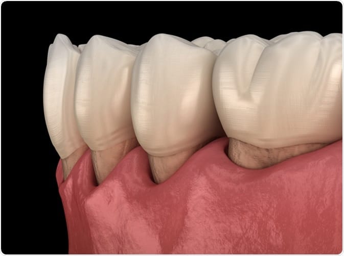 ból zębów spowodowany cofaniem się dziąseł