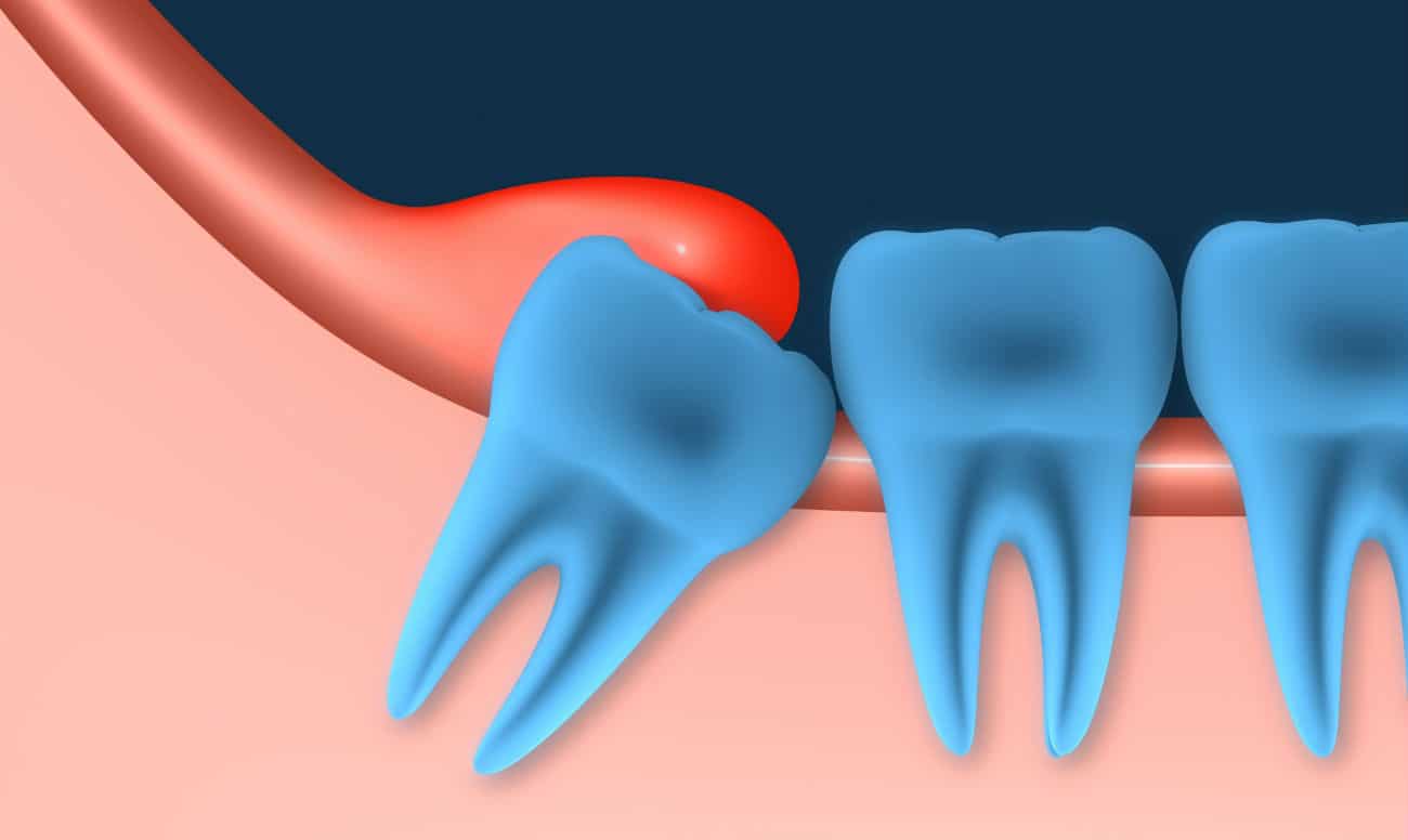toothache from wisdom tooth illustration