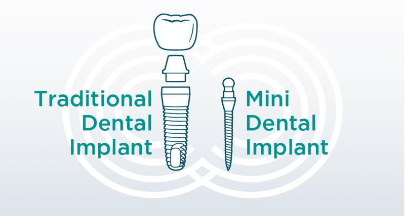 what are mini dental implants boston (waltham) implant dentist blog