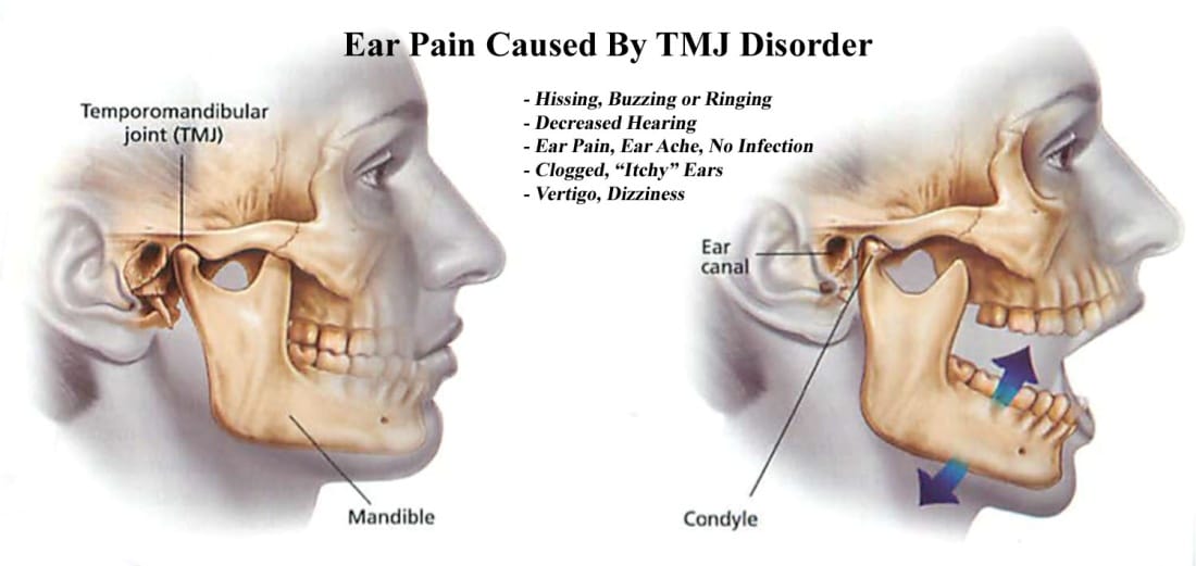Ear pain and tinnitus caused by tmj pain is due to proximity