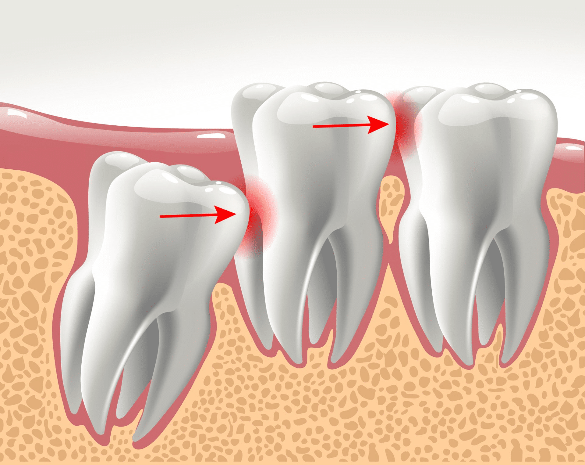 Jakie problemy powodują zęby mądrości, jeśli nie są usuwane?