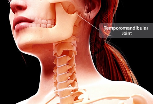 tmj pain and temporomandibular joint disorder can be caused by wisdom teeth illustration