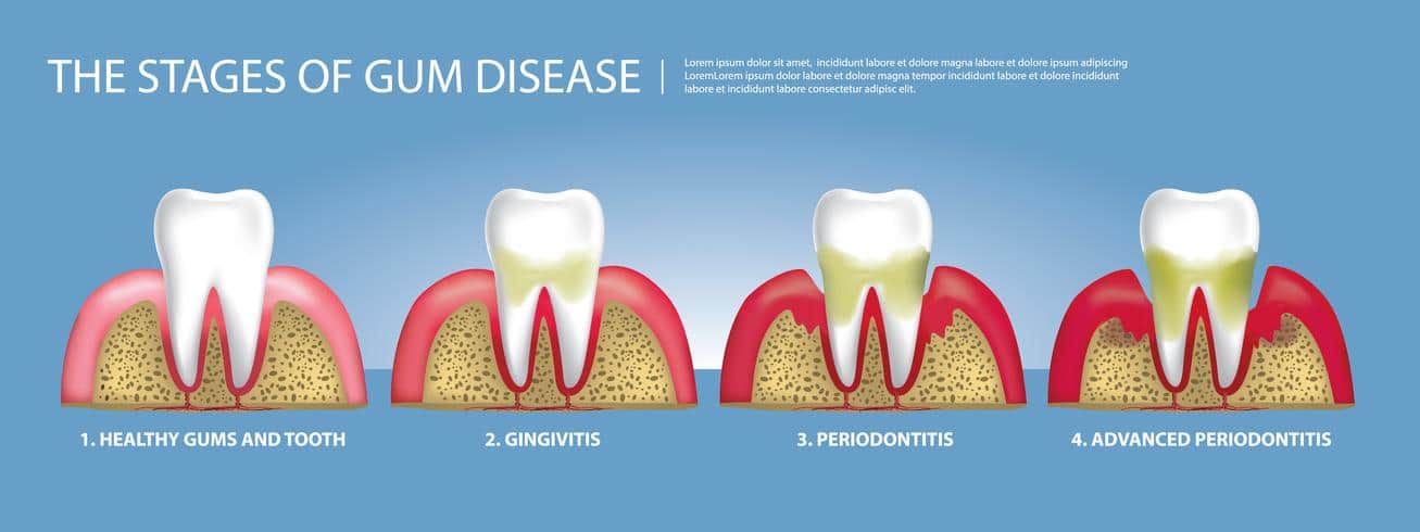 o que é periodontite e estágios da ilustração de doenças gengivais