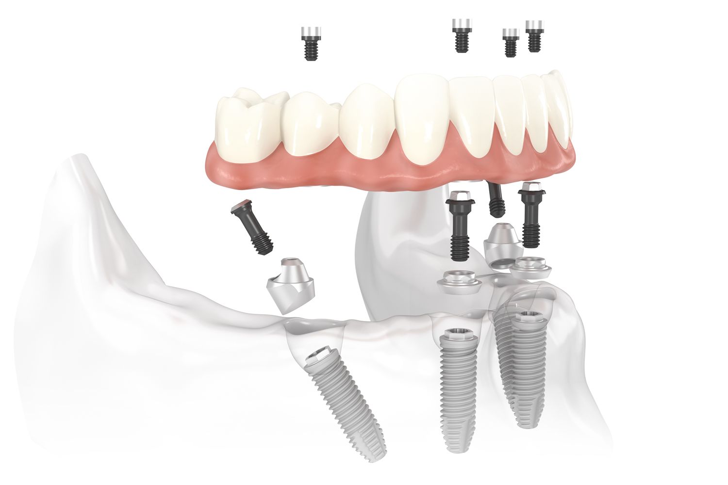 All on 4 clear choice dental implants illustration