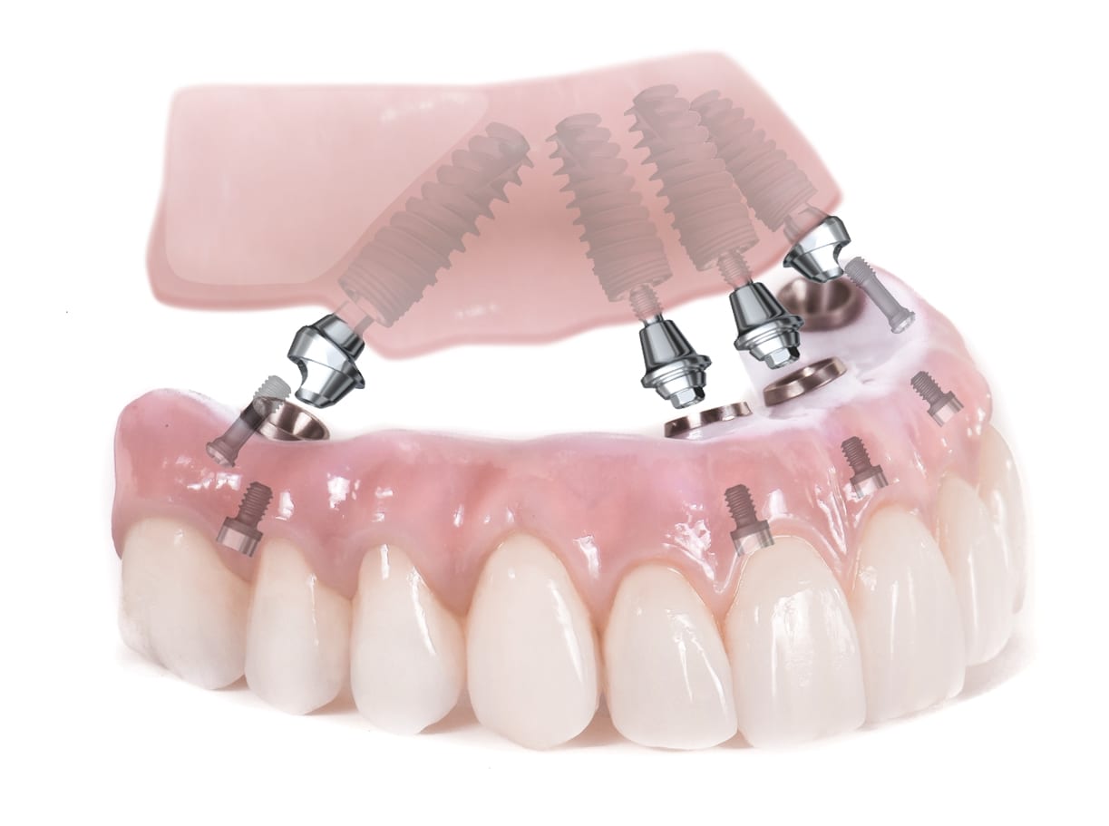 all on 4 dental implant illustration showing how dental implants hold teeth
