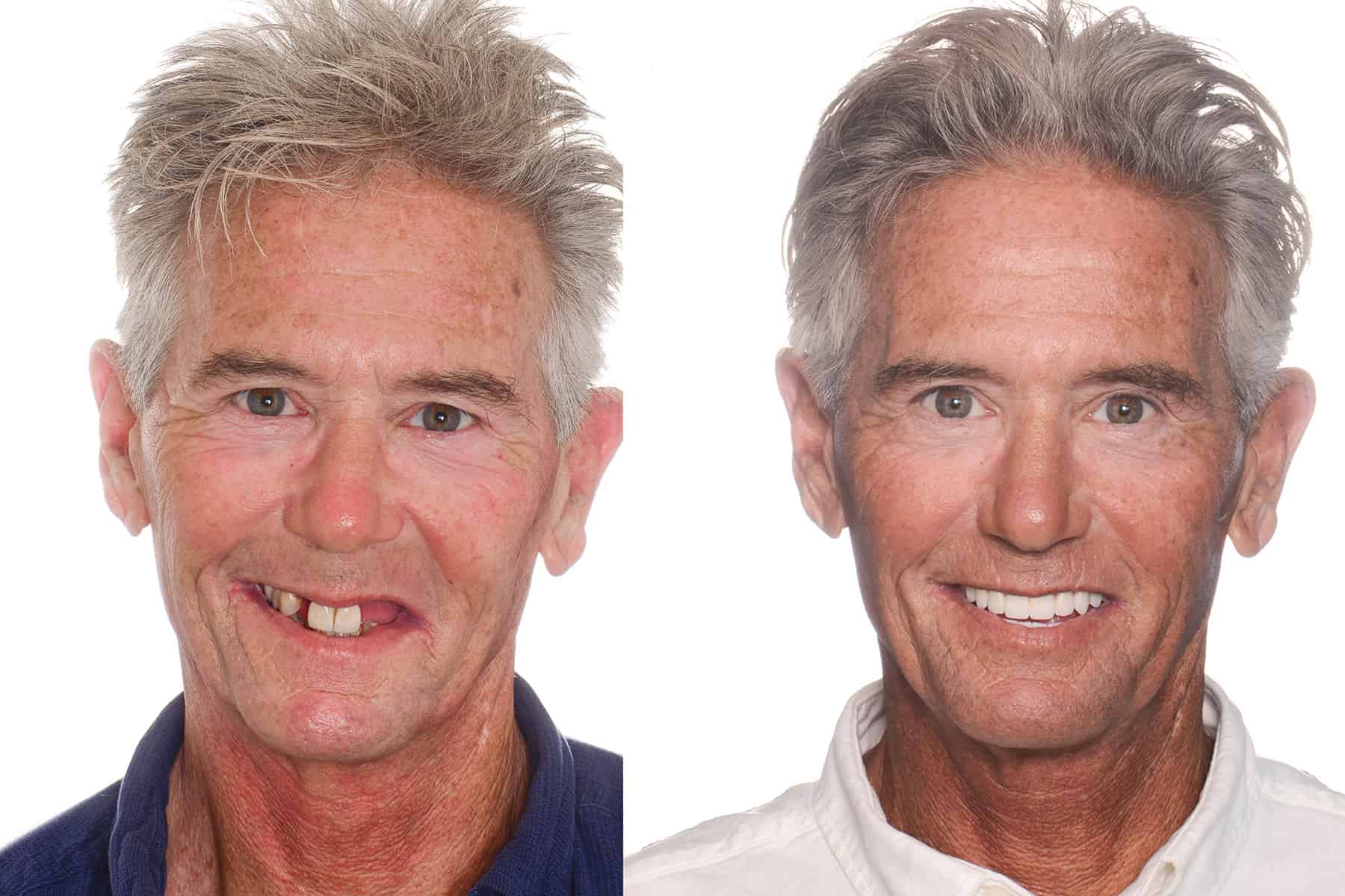 all on 4 dental implants before and after example