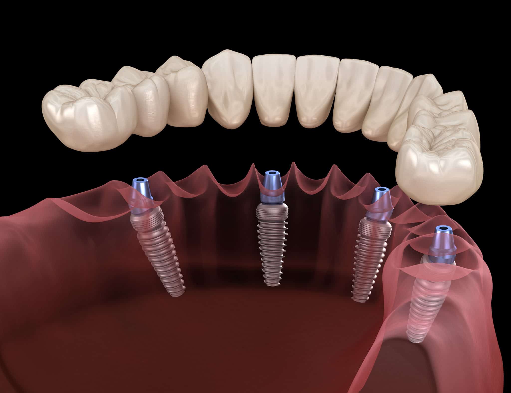 clear choice dental implants featured image
