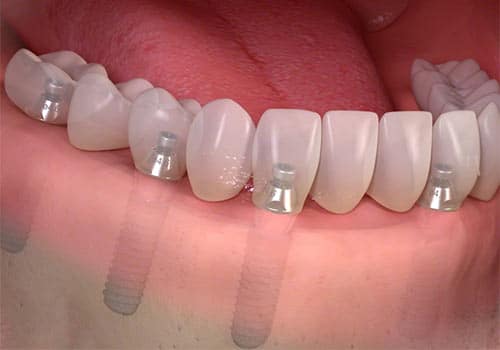 dental implant bridges as alternative to all on 4 dental implants