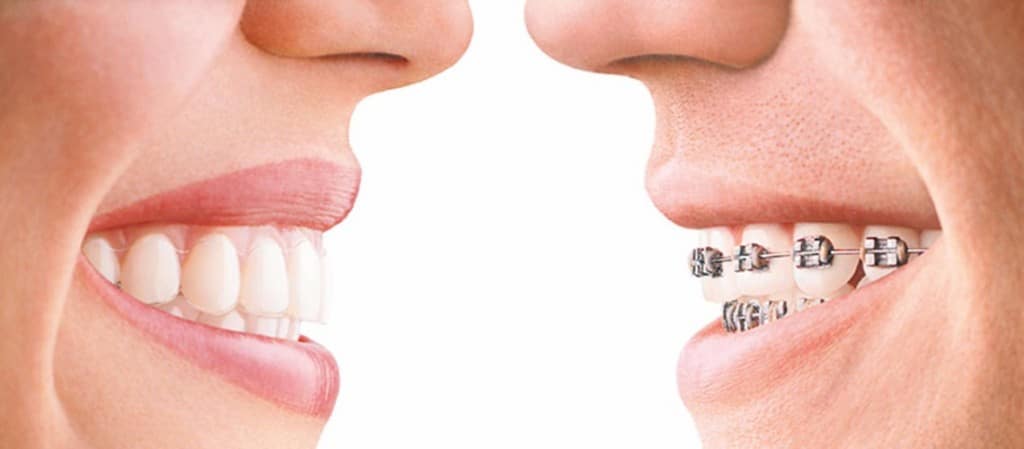Invisalign vs aparat ortodontyczny