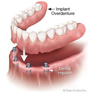 removeable implant denture is alternative to all on 4 dental implants