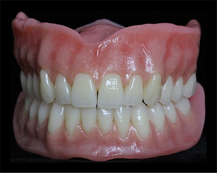 traditional full denture is alternative to all on 4 dental implants