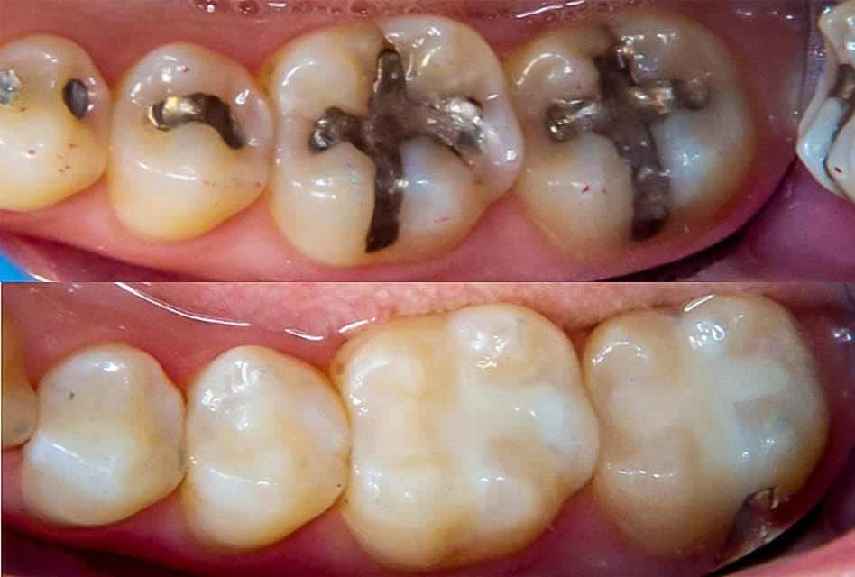 How long does it take to fill a cavity and replace an old filling with a new one