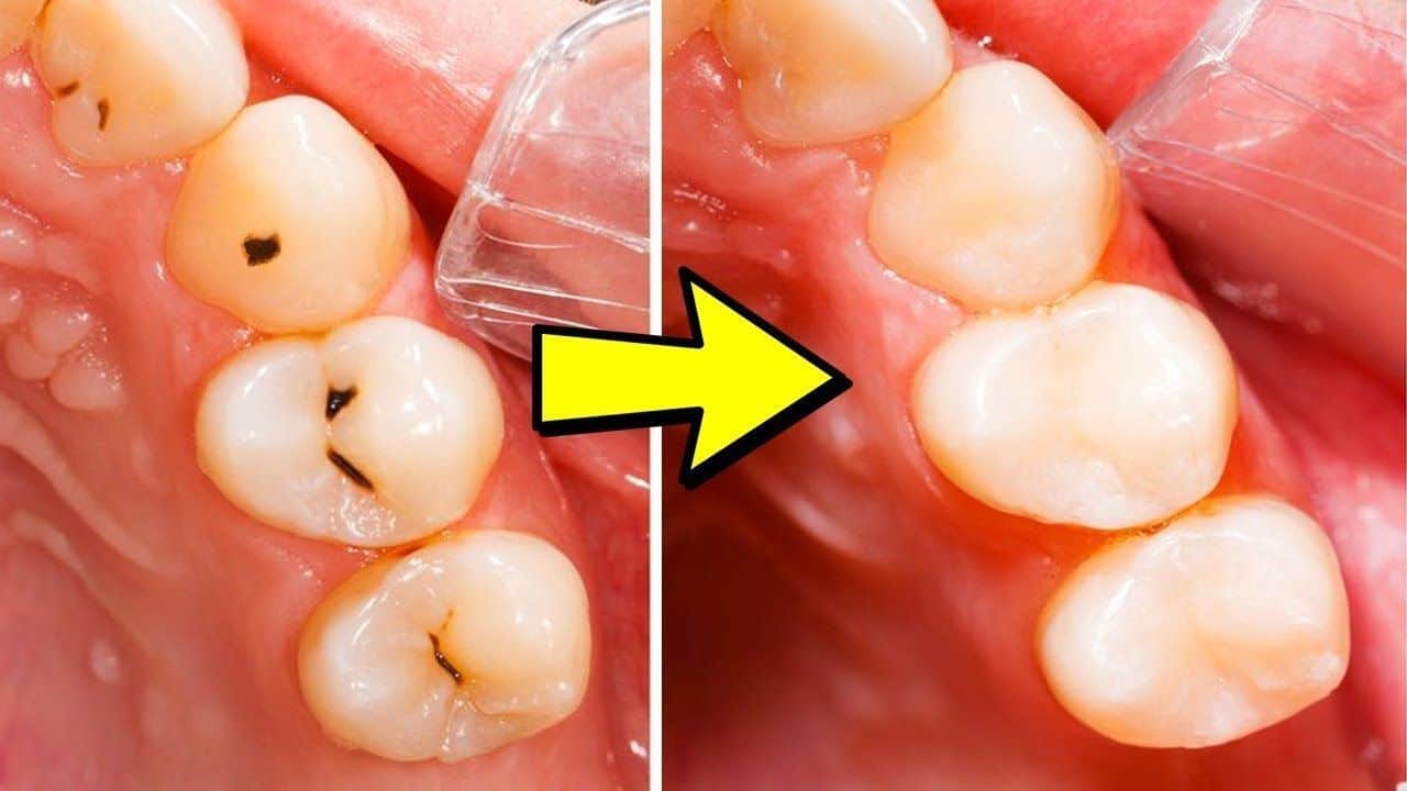 cavities cavity rid tooth decay reverse take fill does heal easy remedy