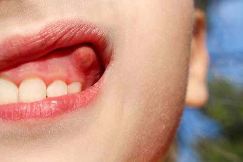 如何判断自己是否有蛀牙 牙齿脓肿的形成