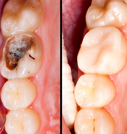 What does a cavity look like, a large cavity
