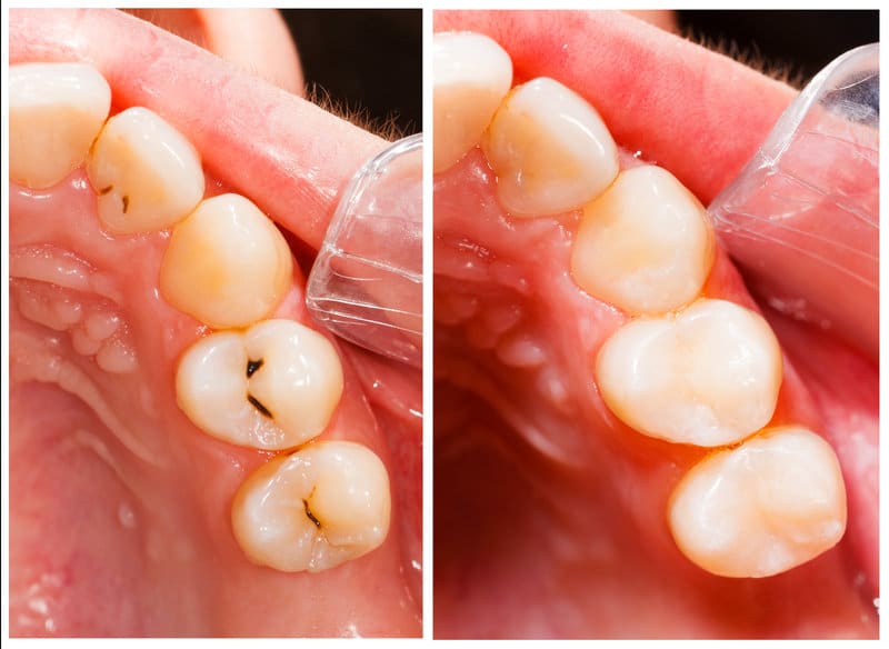 What does a cavity look like, an occlusal cavity