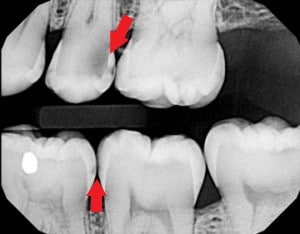 What does a cavity look like on an xray