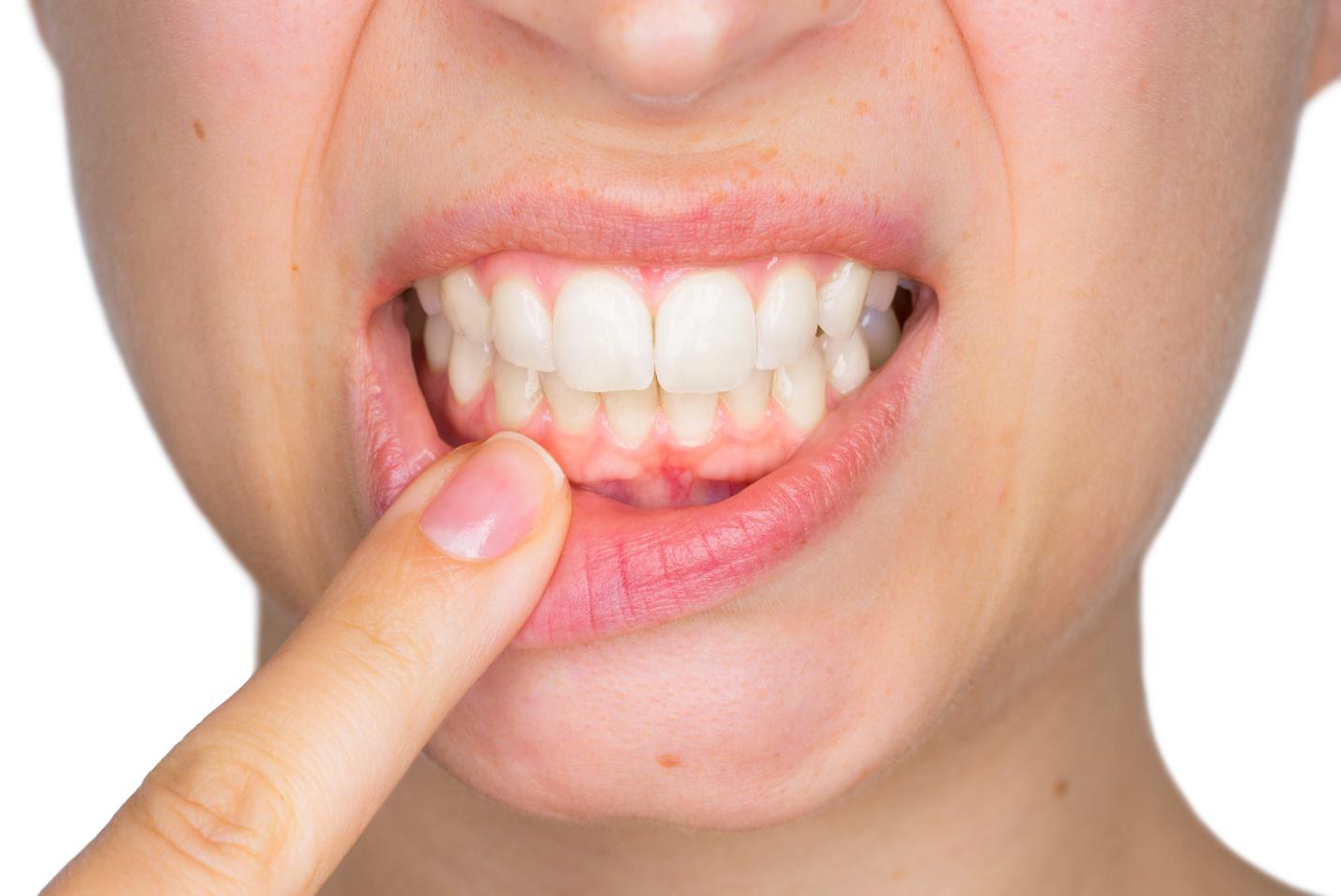 如何阻止牙龈萎缩恶化&牙龈萎缩的自然疗法。
