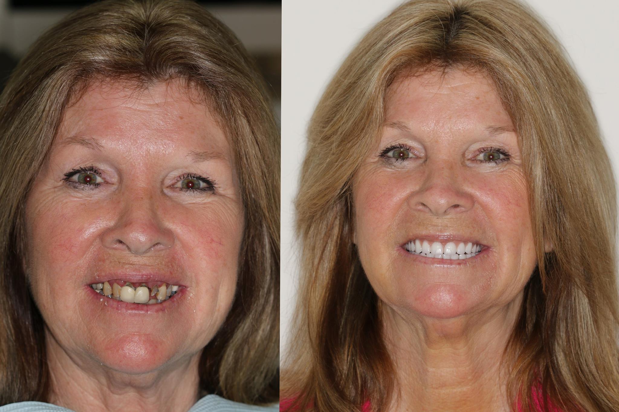 affordable dentures and aspen dental before and after with dentures