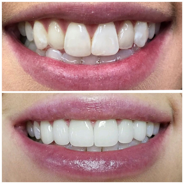 are veneers worth it, before and after