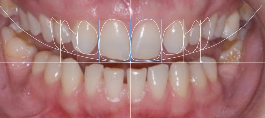 Are Veneers Worth It: The Concise Guide to Dental Veneers