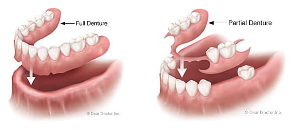 aspen dental vs affordable dentures what is a denture
