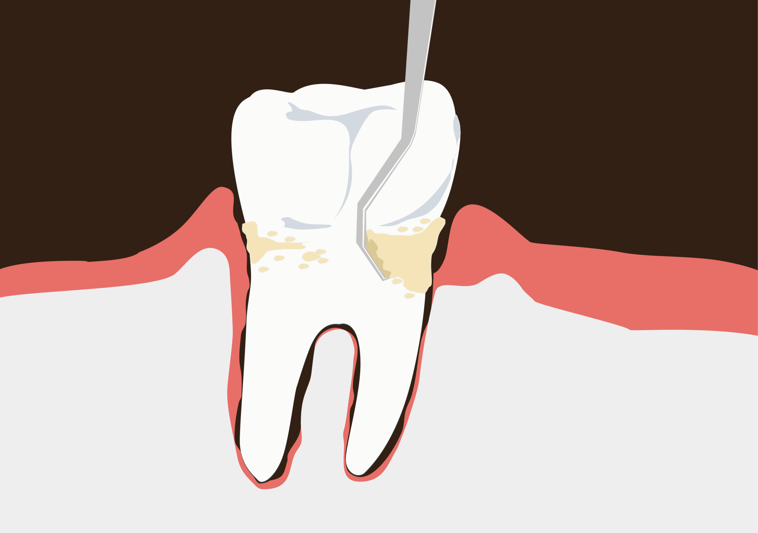 what is a deep dental cleaning & what is scaling and root planing illustration