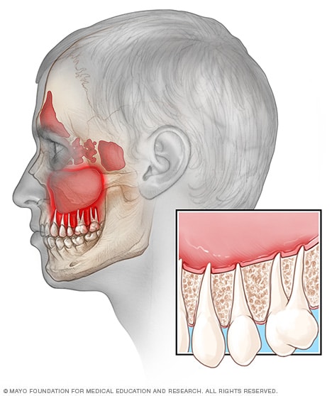 illustratie van de tanden en de sinus