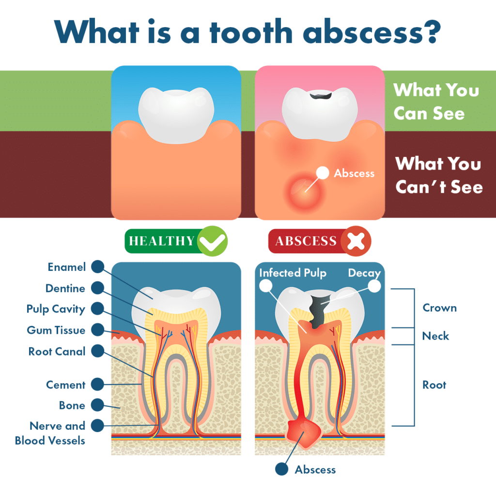¿qué es el dolor de la raíz del diente?