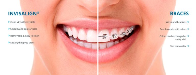 Overbite: What is it and Why Correcting an Overbite is Important