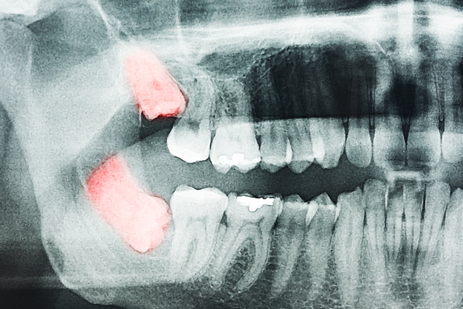 trismus after wisdom tooth extraction is a common symptom