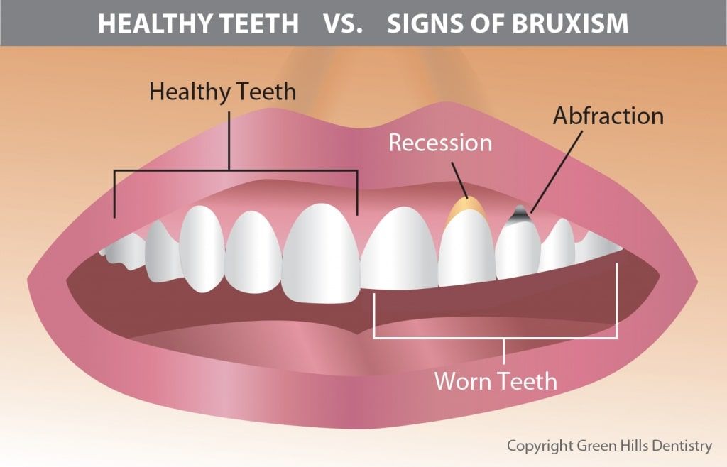 what causes bruxism teeth grinding and orofacial pain