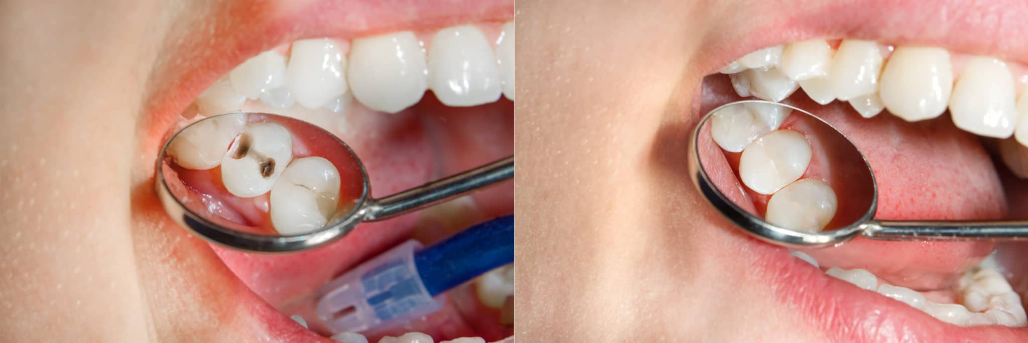 虫歯とは何か、虫歯を治すことはできるのか
