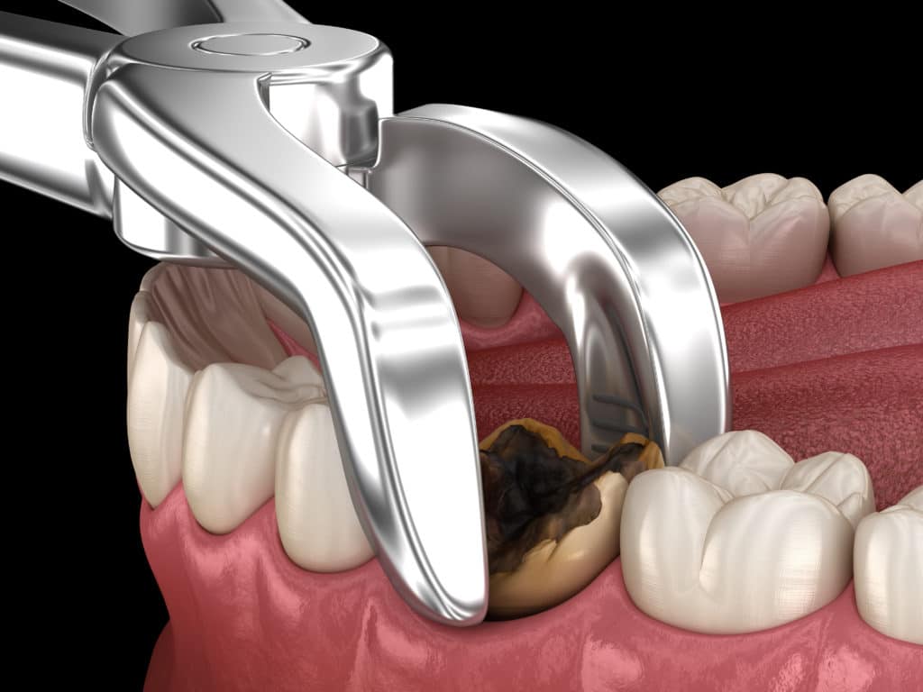 Die Komplexität des Zahns beeinflusst, wie lange eine Zahnextraktion dauert