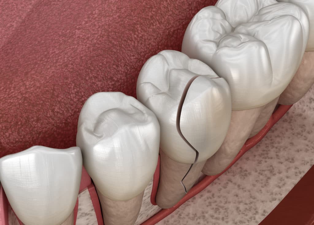 Zahn schmerzt beim Herunterbeißen von gesprungenem Zahn