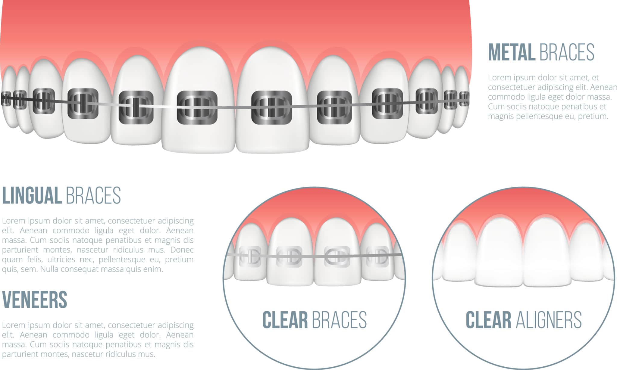 illustrazione dei tipi di apparecchi e come raddrizzare i denti